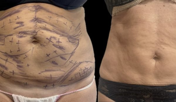 Laser Endolift 1 seduta