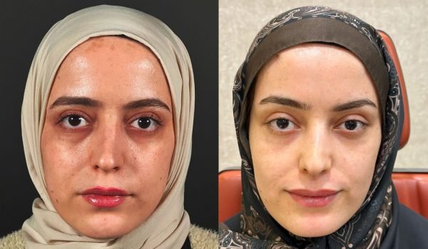 Foto prima e dopo trattamento estetico adaclinic milano 10