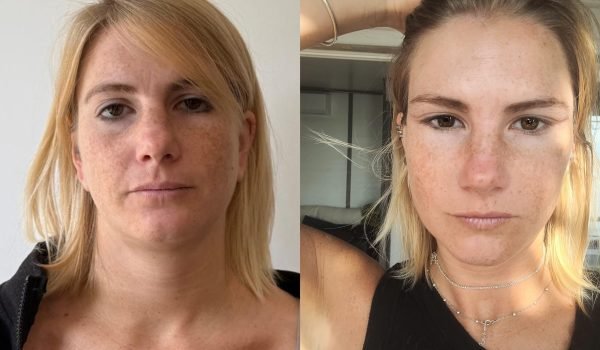 Foto prima e dopo trattamento estetico adaclinic milano 11