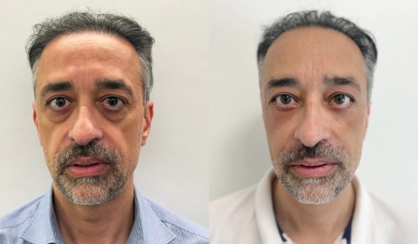 Foto prima e dopo trattamento estetico adaclinic milano 12