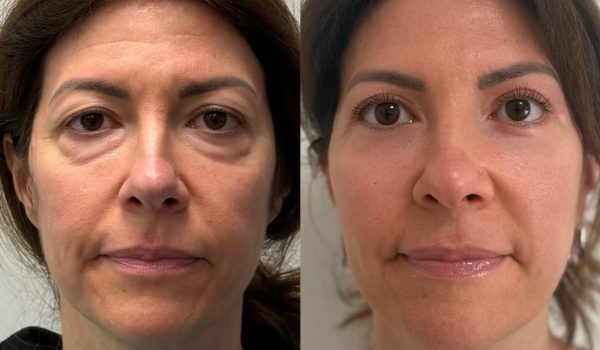 Foto prima e dopo trattamento estetico adaclinic milano 2