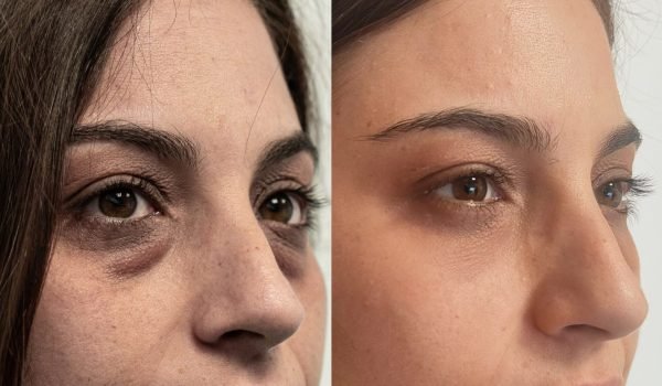 Foto prima e dopo trattamento estetico adaclinic milano 3