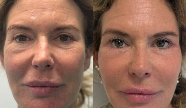 Foto prima e dopo trattamento estetico adaclinic milano 4