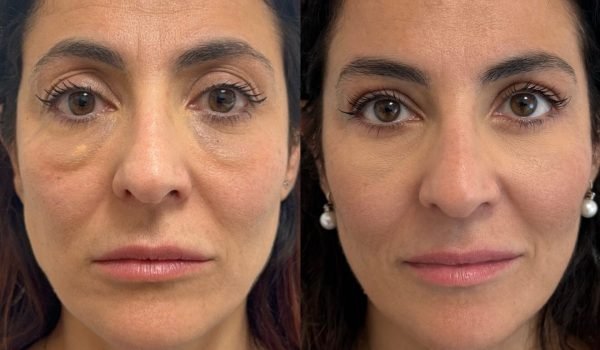 Foto prima e dopo trattamento estetico adaclinic milano 5