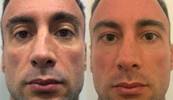 Foto prima e dopo trattamento estetico adaclinic milano 6