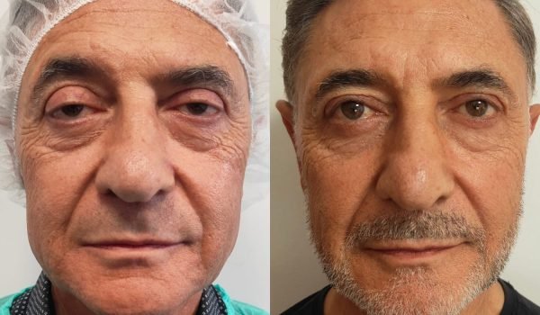 Foto prima e dopo trattamento estetico adaclinic milano 8