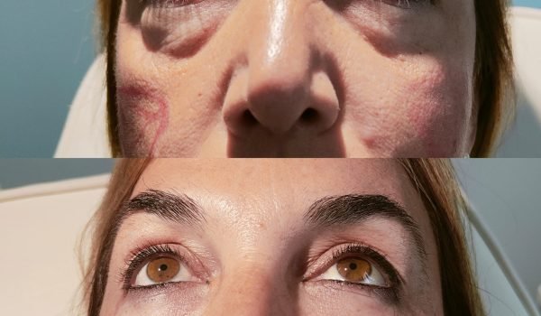 Foto prima e dopo trattamento estetico adaclinic milano 9