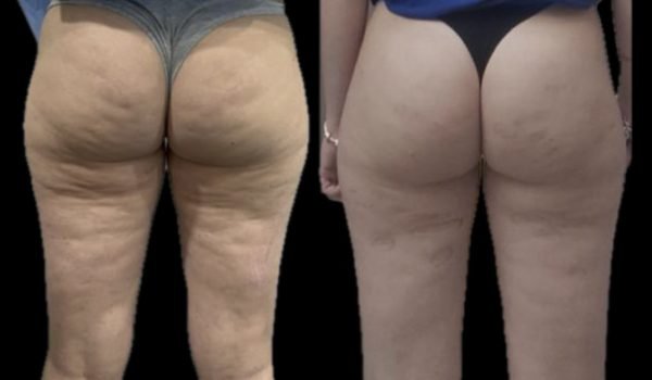Laser endolift per cellulite prima e dopo
