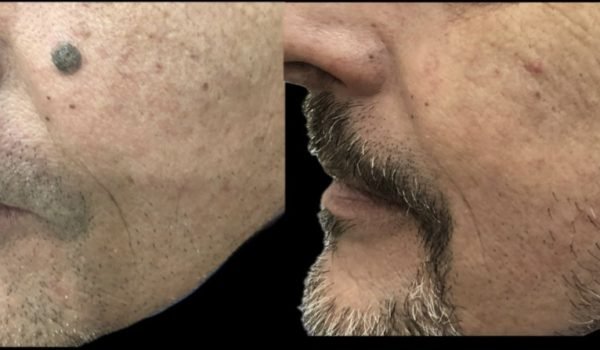 Rimozione cheratosi seborroica con Laser C02 Ablativo