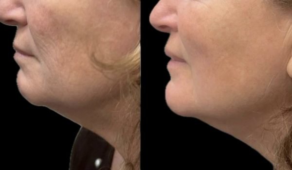 laser endolift viso prima e dopo